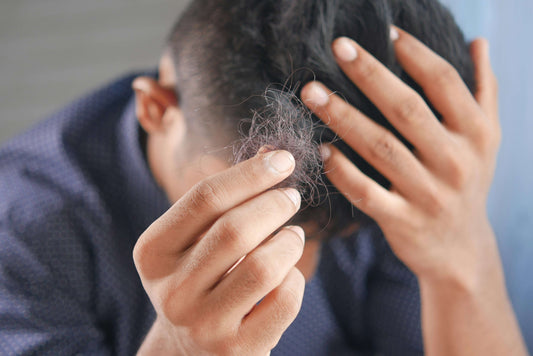 Man Showing His Hair Loss with Head in Hand